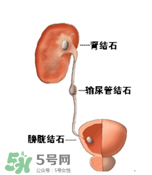 腎結(jié)石有什么癥狀？腎結(jié)石原因