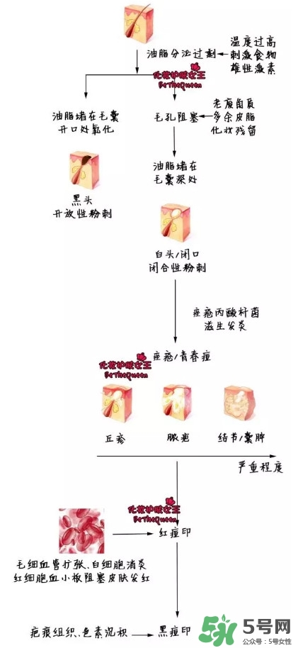 祛紅色痘印用什么藥膏 各色痘印祛除方法