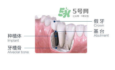 種植牙費(fèi)用多少錢？國產(chǎn)種植牙價(jià)格