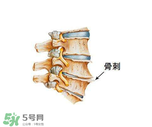 骨刺是怎么形成的？骨刺怎么治療？