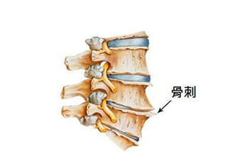 骨刺是怎么形成的？骨刺怎么治療？