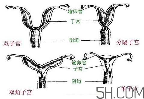 子宮畸形有哪些？子宮畸形有什么影響？