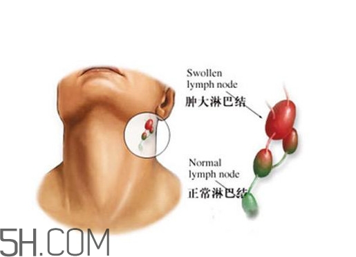 淋巴癌能活多久？淋巴癌癥狀有哪些