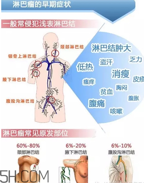 淋巴癌是怎么回事？淋巴癌如何診斷