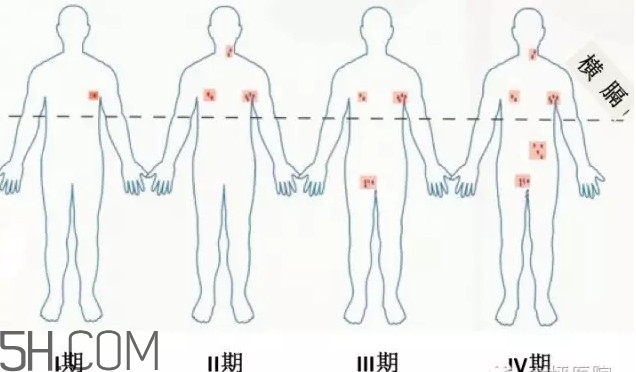 淋巴癌是怎么回事？淋巴癌如何診斷