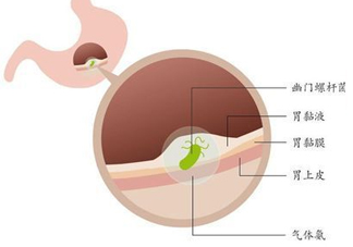 幽門螺桿菌的癥狀有哪些表現(xiàn)？幽門螺旋菌怎么治療