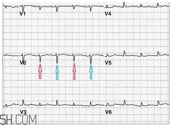 心電圖怎么看？6種常見心電圖異常情況