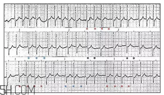 心電圖怎么看？6種常見心電圖異常情況