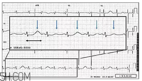 心電圖怎么看？6種常見心電圖異常情況