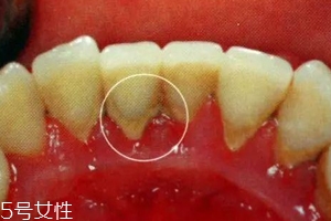 牙結(jié)石能自動脫落嗎？除了洗牙別無他法