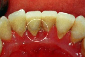 牙結(jié)石能自動脫落嗎？除了洗牙別無他法