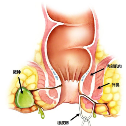 肛瘺非手術(shù)治療才可以嗎？手術(shù)是治療的關(guān)鍵途徑