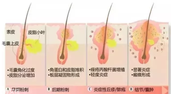 封閉性粉刺的發(fā)病機(jī)制是什么？角質(zhì)層太厚