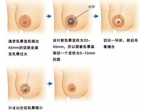 乳暈縮小術(shù)怎么做？乳暈縮小術(shù)知識(shí)全解