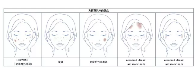 祛斑美白什么產品最有效 日常祛斑小妙招