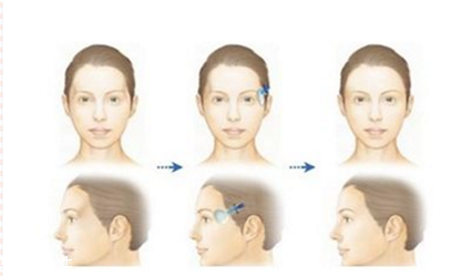 自體脂肪填充過多怎樣補(bǔ)救 自體脂肪填充過多解決方法