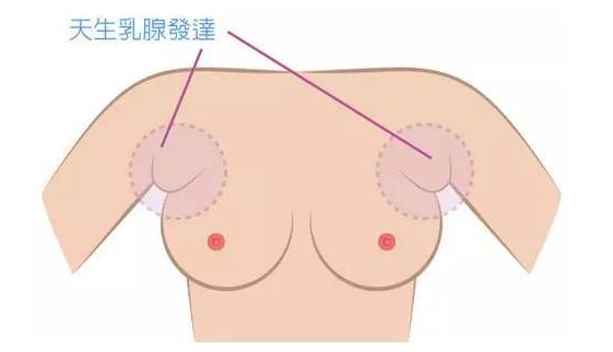 假副乳和真副乳的區(qū)別 前者能快速消除