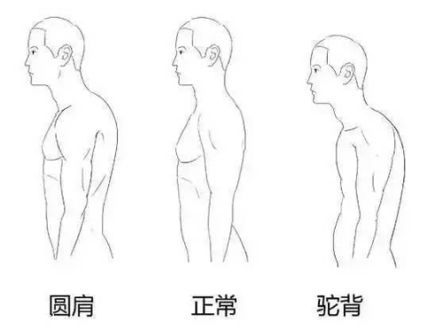 圓肩駝背怎么矯正 教你如何矯正圓肩駝背