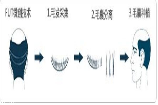 植發(fā)疼嗎 植發(fā)的步驟