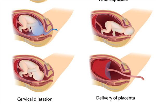 分娩過程的順序 全程疼痛劇烈