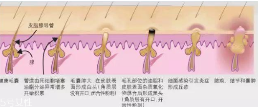 臉上閉口太多怎么辦 臉上長閉口怎么調理