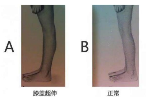 膝關節(jié)超伸的表現 快來自測一下把