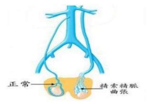 什么是經脈曲張 將脈曲張的危害是什么