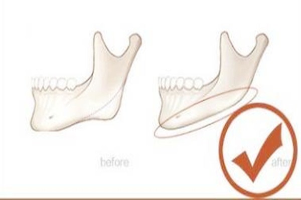 什么人適合下頜角整形手術(shù) 下頜角整形手術(shù)多久能消腫