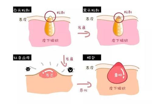 適合長脂肪粒用的眼霜 長脂肪粒適合用什么護膚品