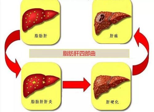 脂肪肝患者一點(diǎn)肉都不能吃嗎 脂肪肝適合高蛋白嗎