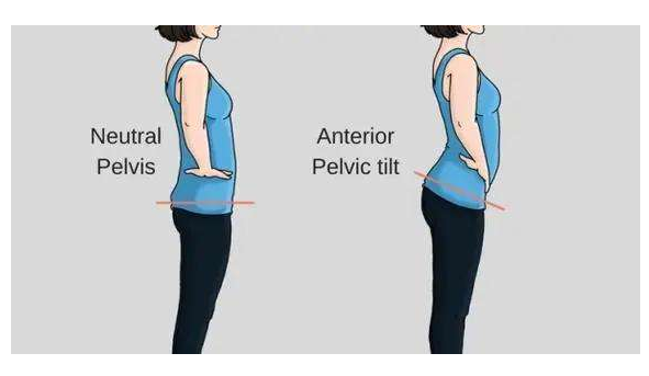 骨盆前傾是怎么造成的 什么睡姿可以矯正骨盆前傾