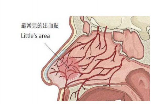 經常流鼻血是怎么回事 經常流鼻血怎么辦