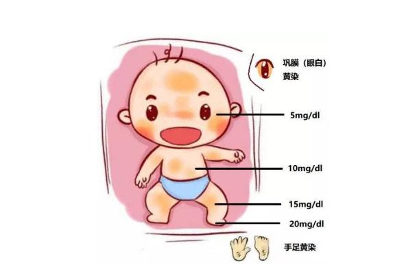 新生兒黃疸會造成什么影響 新生兒黃疸會嗜睡嗎