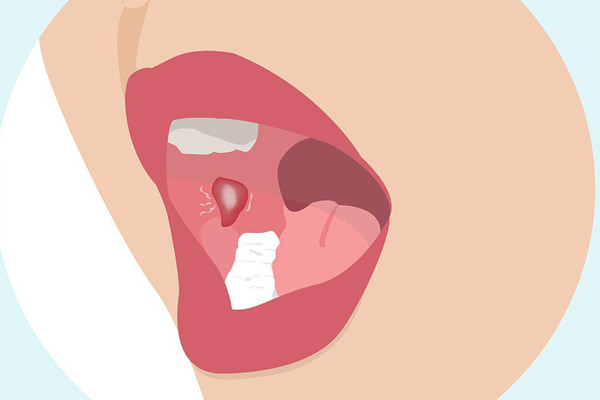 口腔潰瘍會導致臉腫嗎 口腔潰瘍會導致喉嚨痛嗎