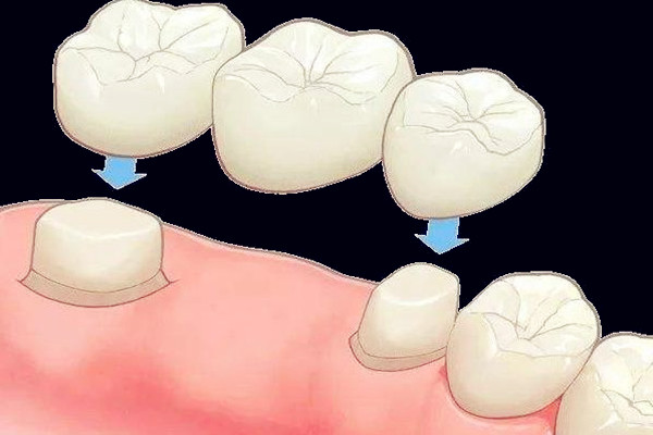 烤瓷牙什么人不能做 烤瓷牙能用沖牙器嗎