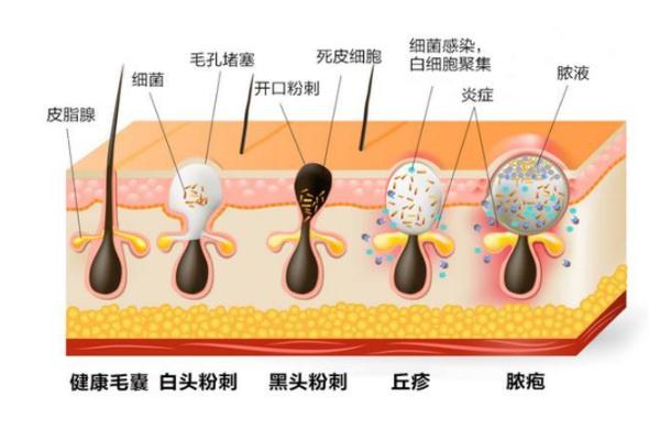 粉刺要不要擠出來 粉刺要怎么處理