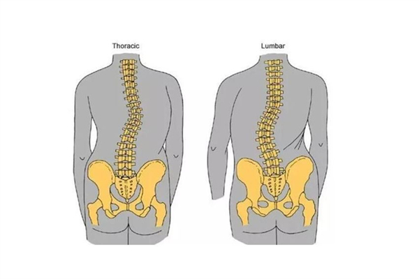 骨盆前傾可以通過(guò)正骨恢復(fù)嗎 骨盆前傾去哪里矯正