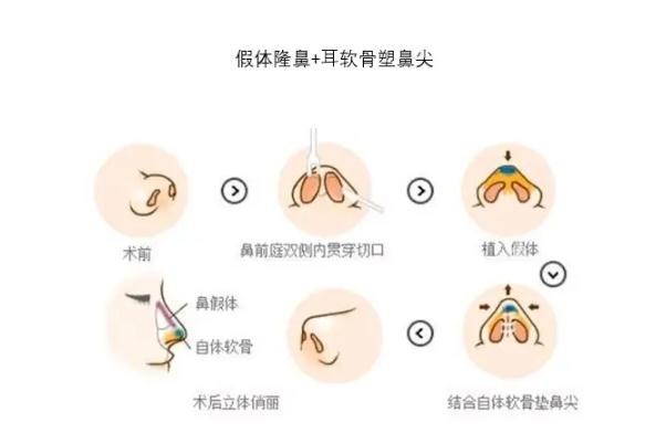 耳軟骨隆鼻可以維持多久 耳軟骨隆鼻需要多少錢