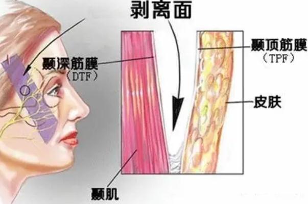 拉皮手術(shù)的疤痕多久消失 拉皮手術(shù)是全麻還是局麻