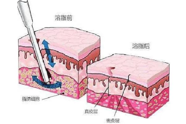 溶脂針會導(dǎo)致皮膚松弛嗎 溶脂針會影響月經(jīng)嗎