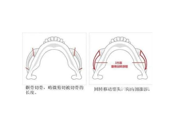 顴骨內(nèi)推的釘子需要取出嗎 顴骨內(nèi)推是幾級手術(shù)