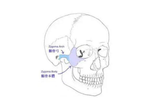 顴骨內(nèi)推要開(kāi)刀嗎 顴骨內(nèi)推有生命危險(xiǎn)嗎