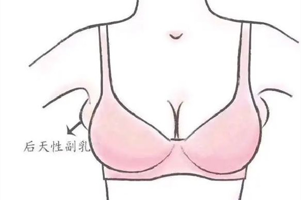 副乳切除手術(shù)是全麻還是局麻 副乳切除手術(shù)后多久可以正?；顒?dòng)