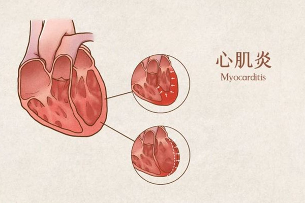 心肌炎早期的癥狀和前兆 心肌炎有潛伏期嗎