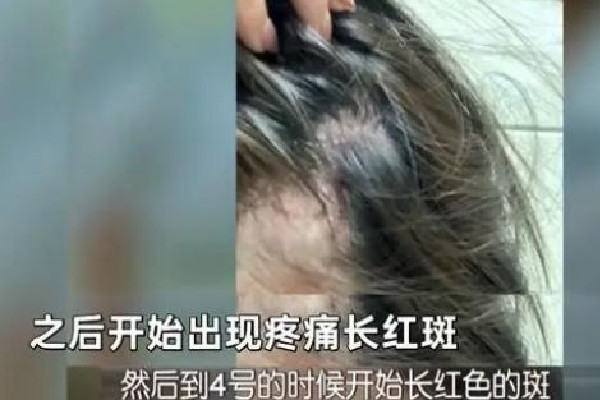 空姐注射玻尿酸打進血管險喪命 玻尿酸注射是肌肉注射嗎